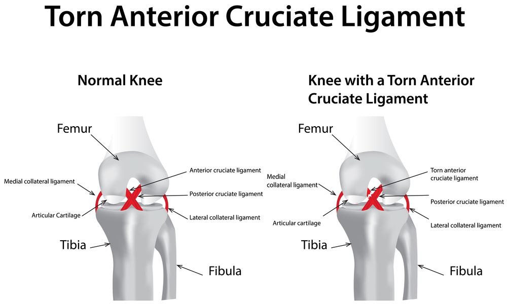 Anatomy Of The Anterior Cruciate Ligament (ACL) Injury